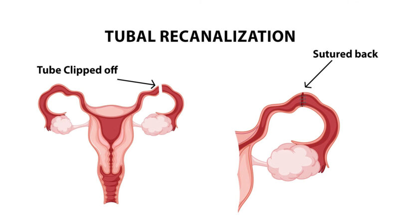 TUBAL LIGATION REVERSAL