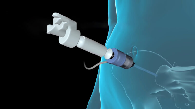 Tubal Ligation Surgery Visual