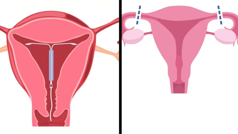 Tubal Ligation Visualize